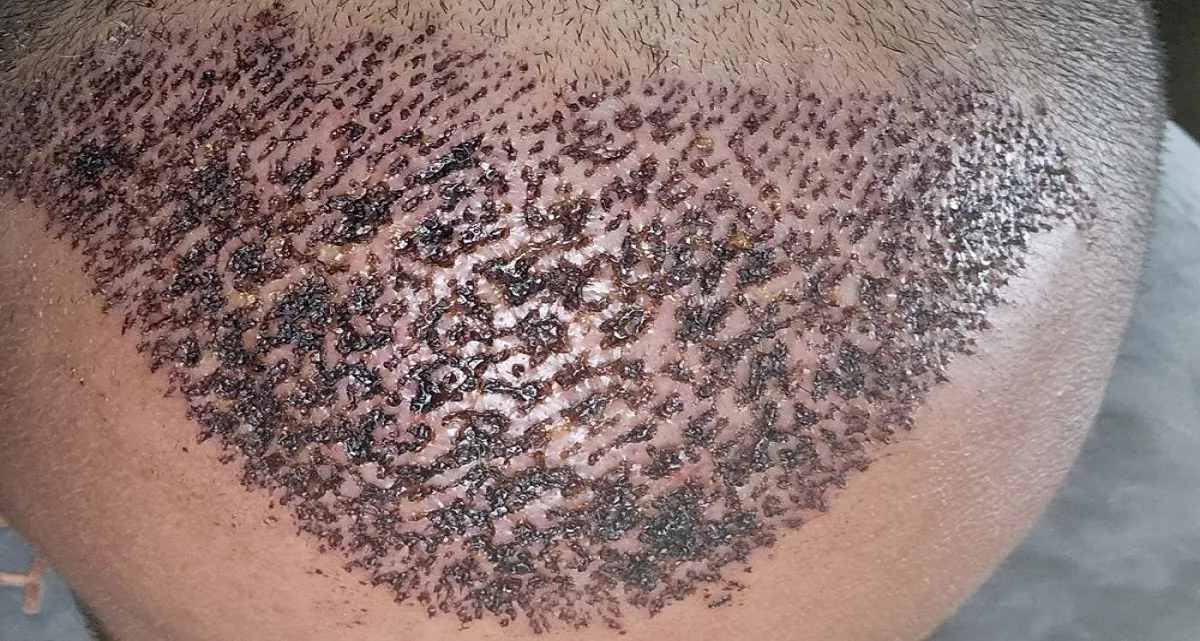 کاشت مو به روش FUT