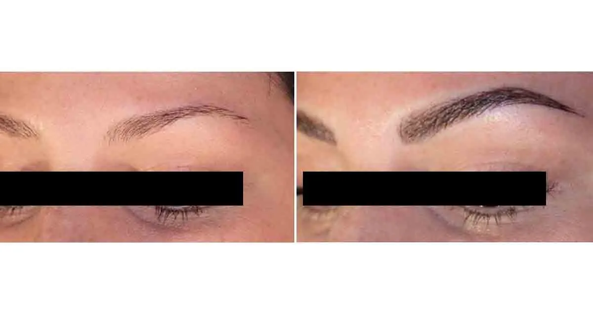 عکس قبل و بعد کاشت ابرو به روش FUT