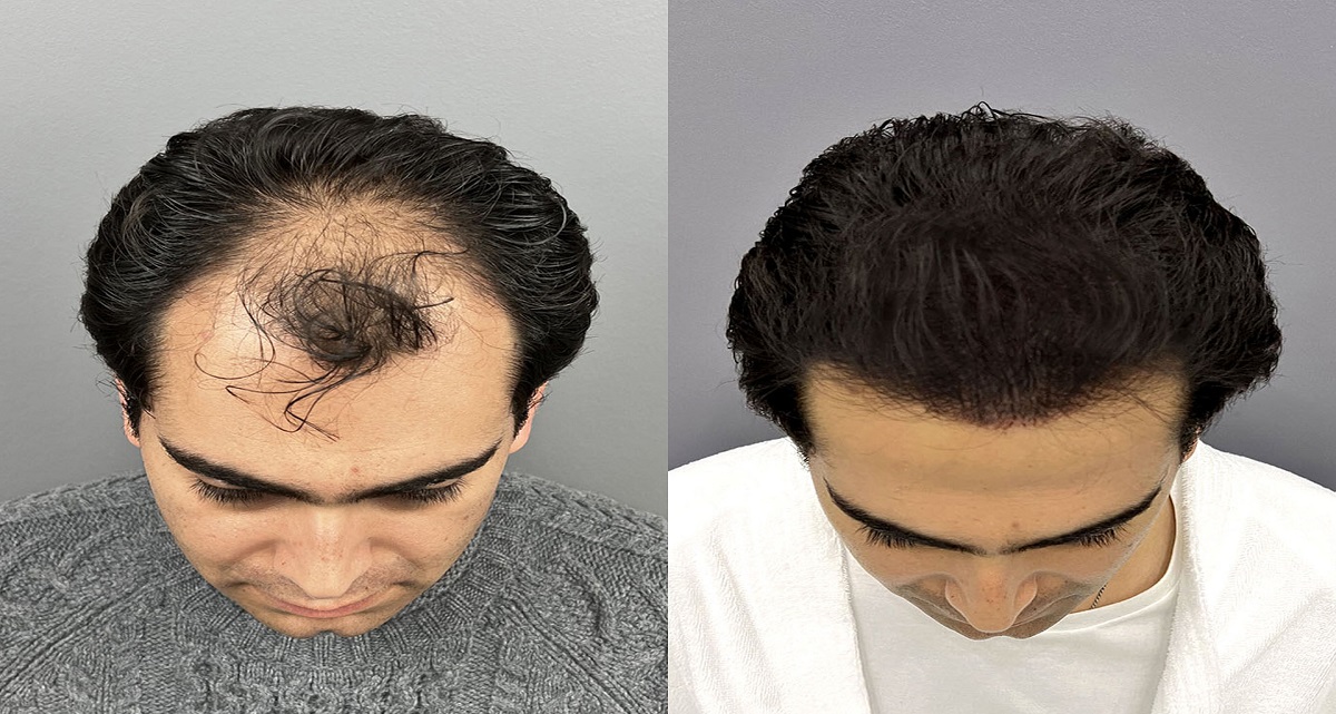 کاشت مو به روش اف یو ای