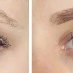 سن مناسب کاشت ابرو