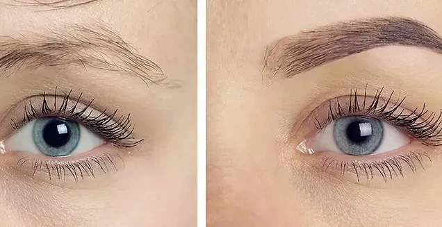 سن مناسب کاشت ابرو