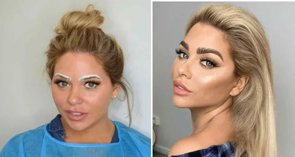 گوشت قرمز بعد از کاشت ابرو