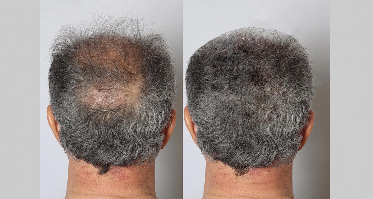 عکس قبل و بعد کاشت مو کاشت مو به روش BHT 