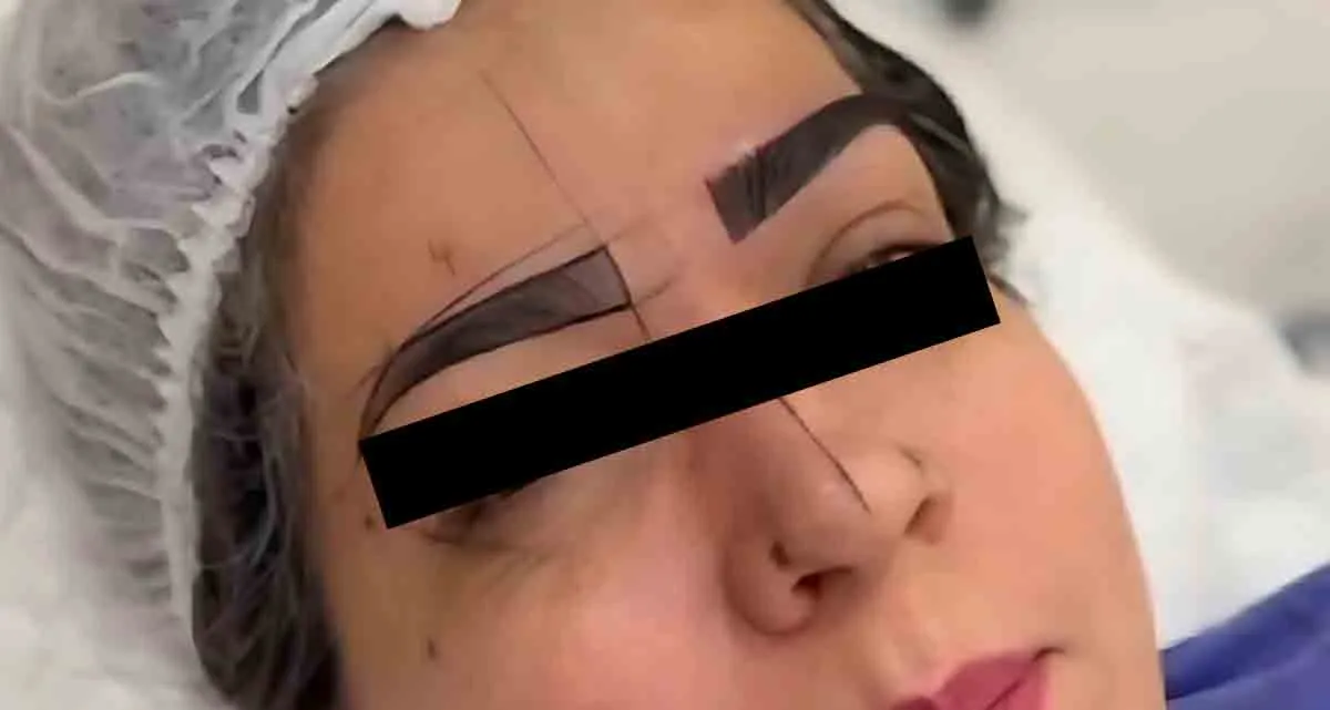 عکس قبل و بعد کاشت ابرو به روش DHI