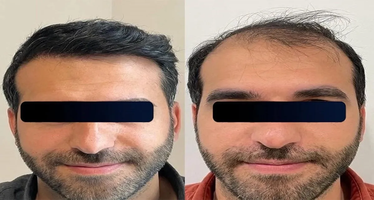 قبل و بعد کاشت مو به روش بایوفایبر