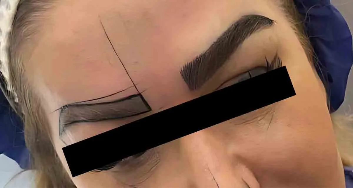 عکس قبل و بعد کاشت ابرو Super FUE