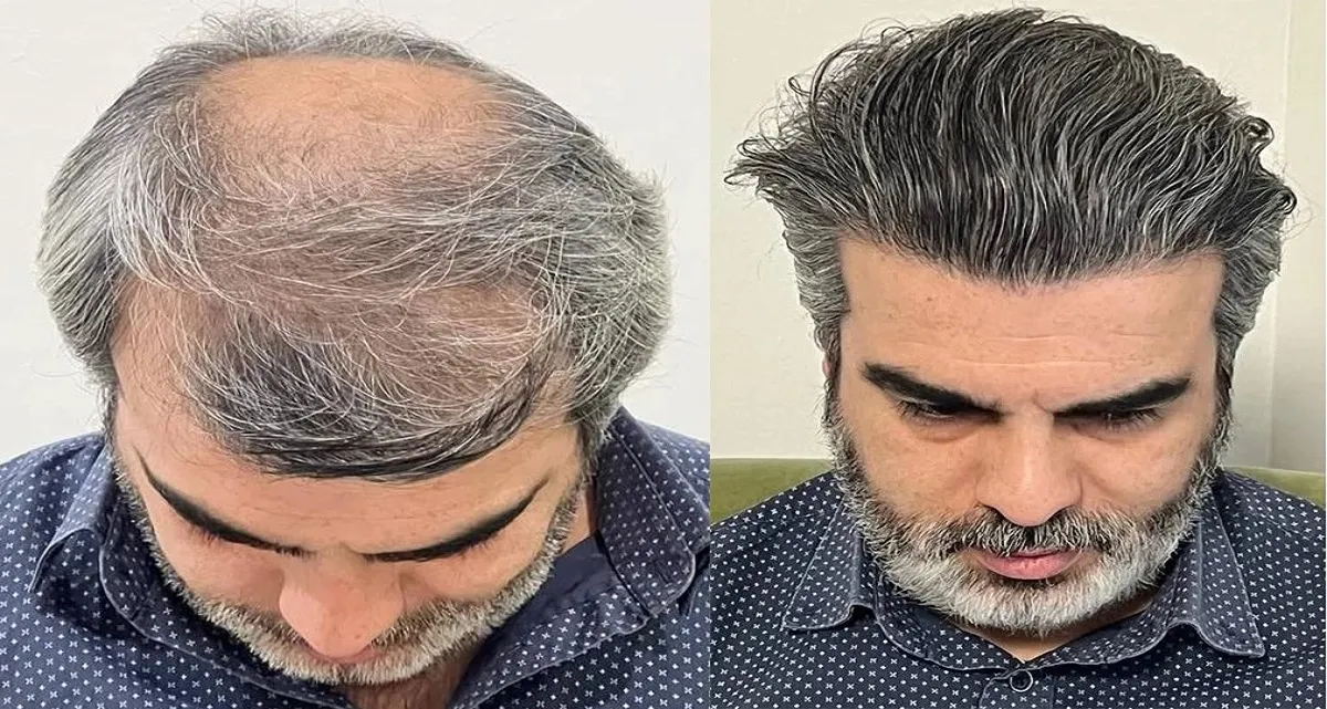 قبل و بعد کاشت مو به روش fit