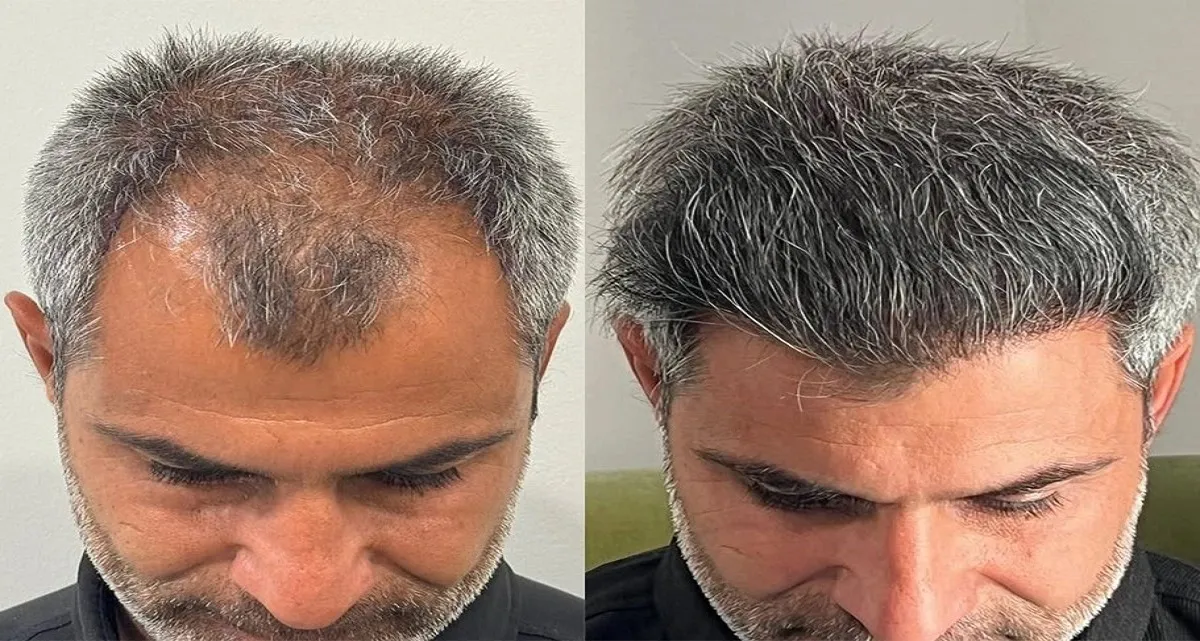 قبل و بعد کاشت مو به روش FUT