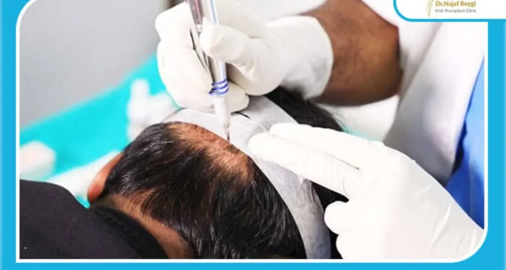 بهترین مرکز کاشت مو در تهران