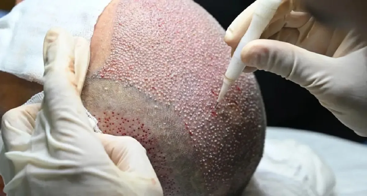 کاشت مو به روش FUT