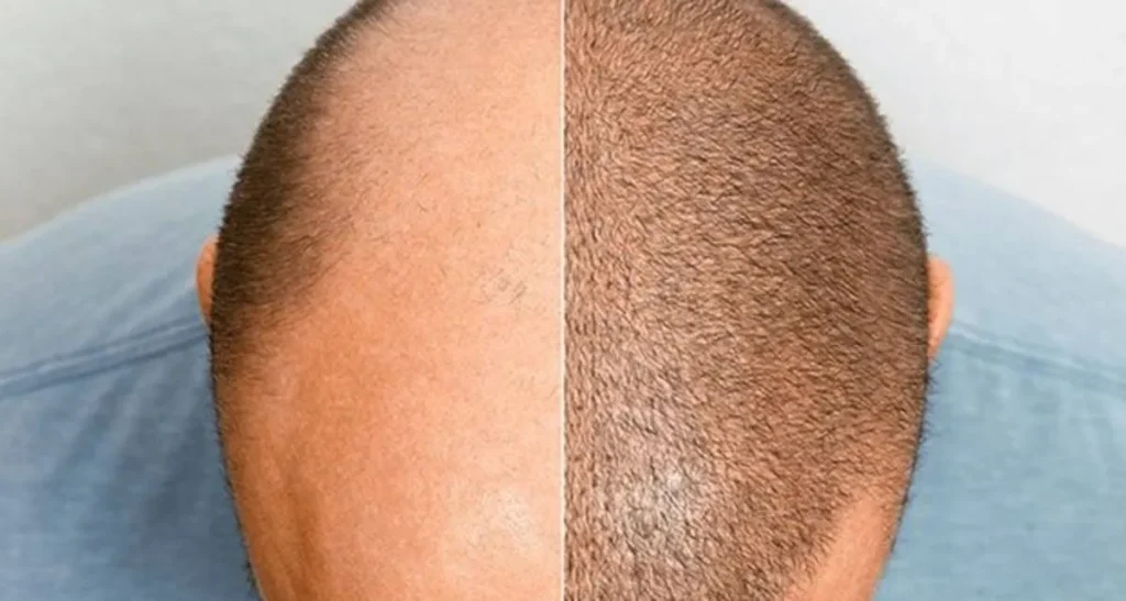 اگر پوست سر چرب باشد کاشت مو جواب می دهد؟