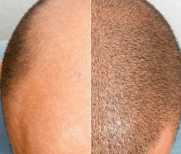 کاشت مو برای موی چرب امکان پذیر است