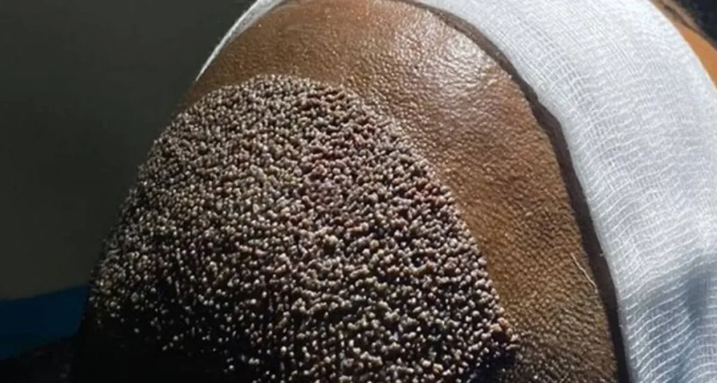 آیا کاشت مو روی پوست سر چرب امکان‌پذیر است