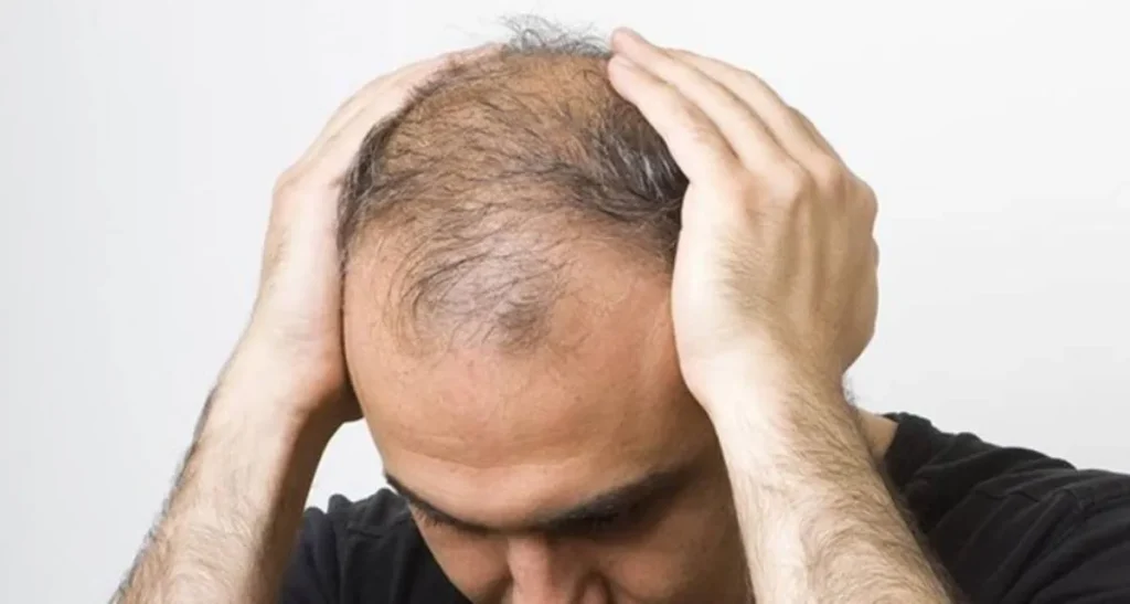 نحوه درمان ریزش مو در جوانان