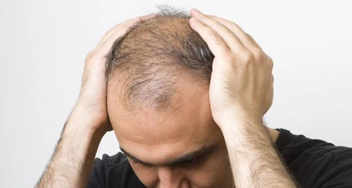 نحوه درمان ریزش مو در جوانان