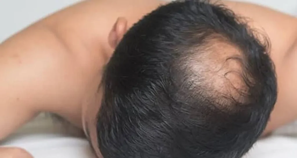 علت ریزش مو در نوجوانان و جوانان