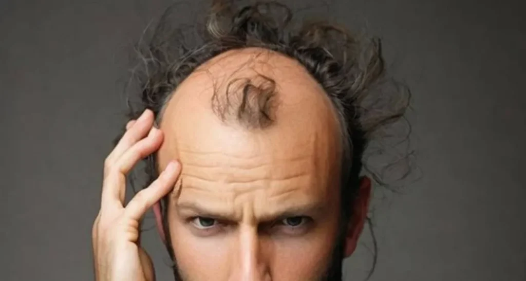 درمان ریزش مو در جوانان و نوجوانان