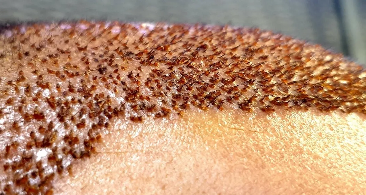 کاشت مو به روش HRT