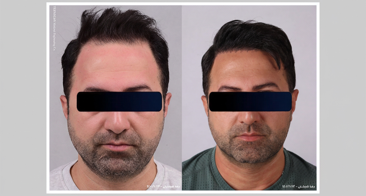 کاشت مو میکروگرافت چیست؟