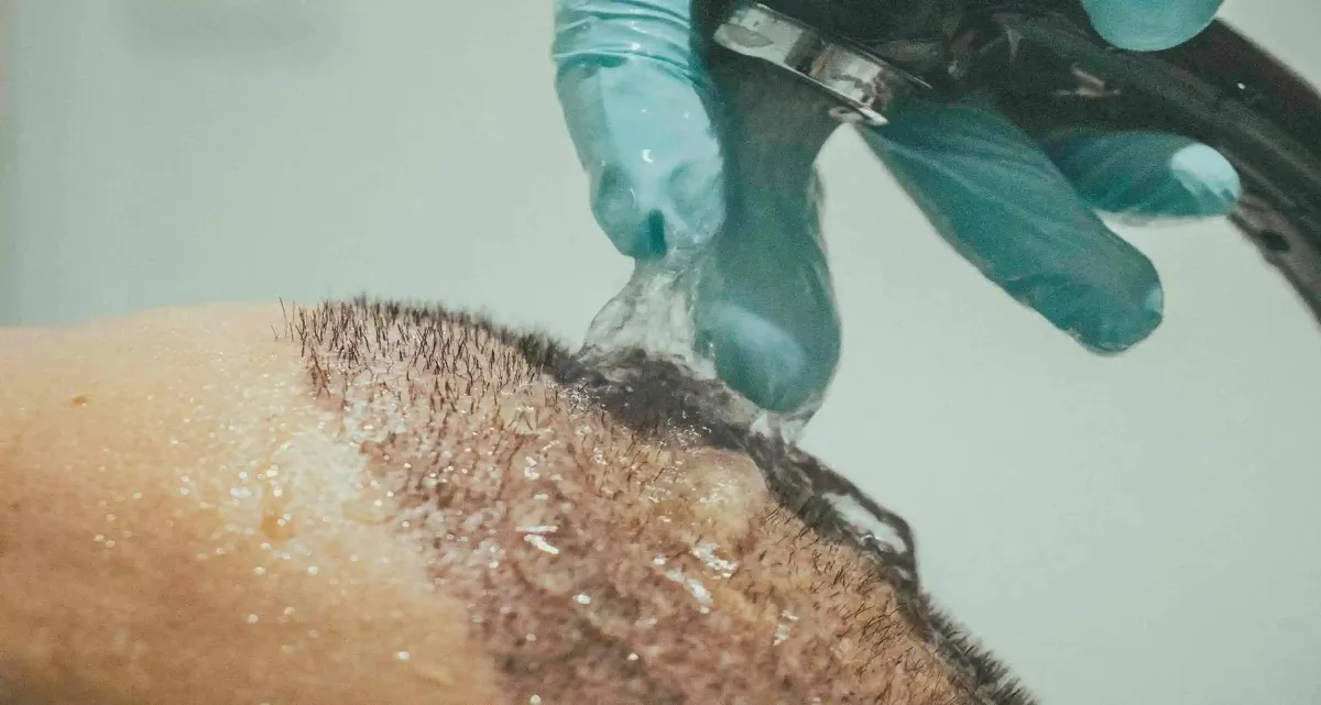 مراقبتهای بعد از کاشت مو به روش Super FUE