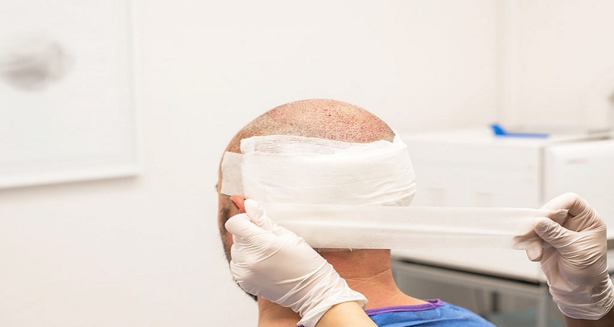 کاشت مو به روش fit چیست؟