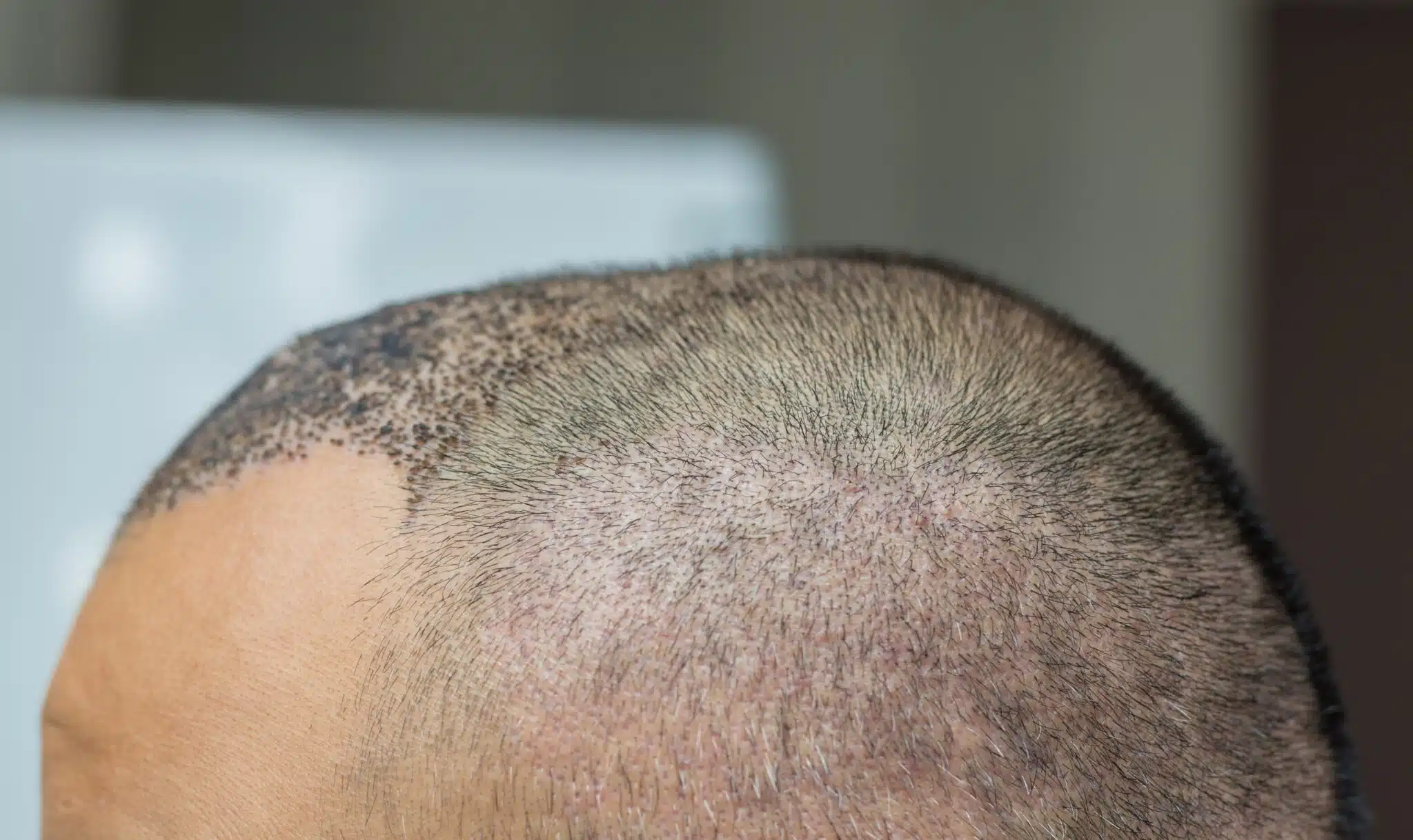 کاشت مو Super FUE