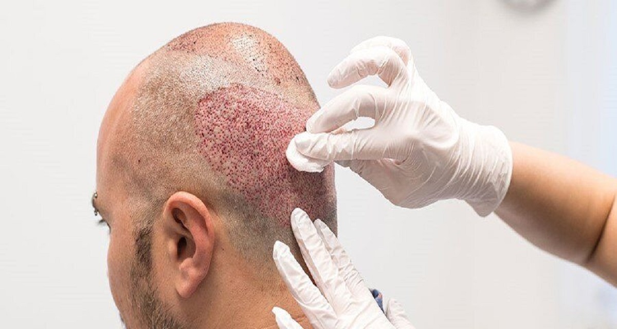 کاربرد کاشت مو به روش fit