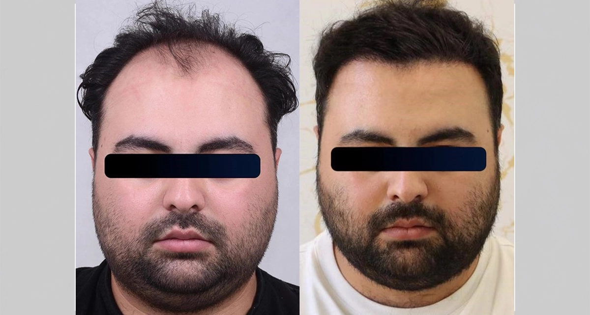 عکس قبل و بعد کاشت مو به روش سیفر