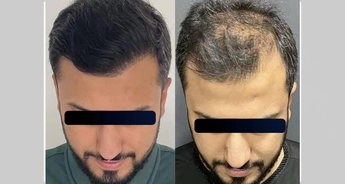 کاشت مو به روش میکروفیت چیست؟