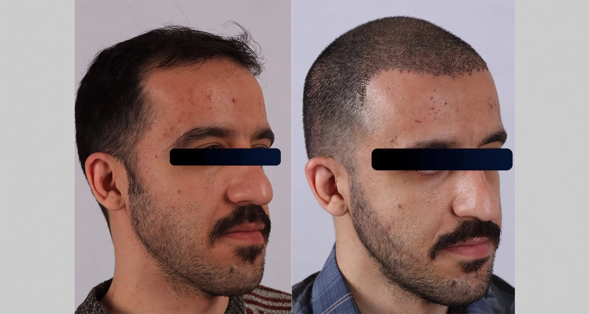 عکس قبل و بعد کاشت مو به روش سیفر