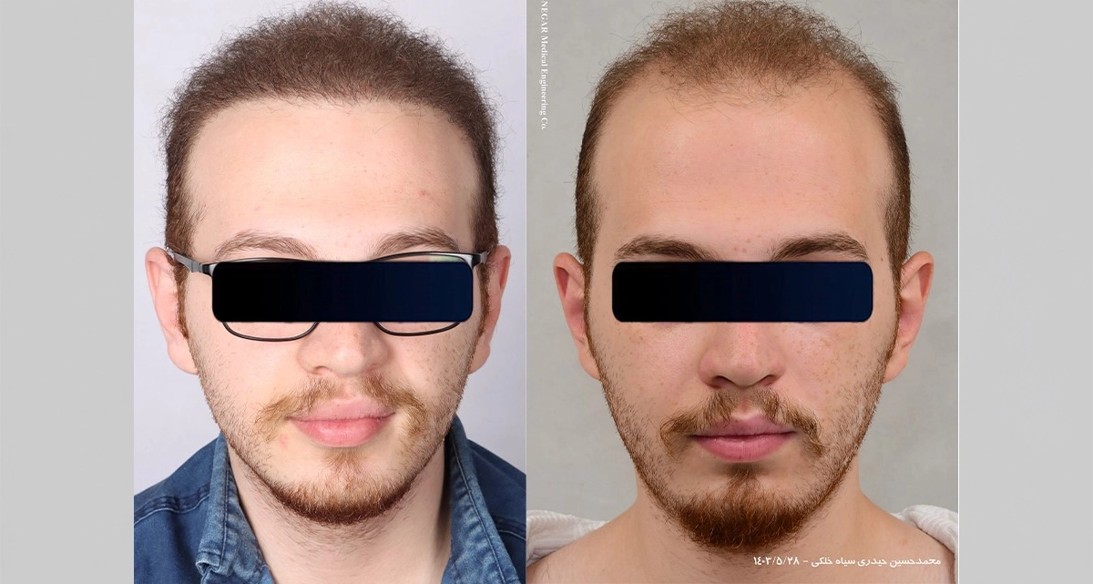 عکس قبل و بعد کاشت مو به روش HRT