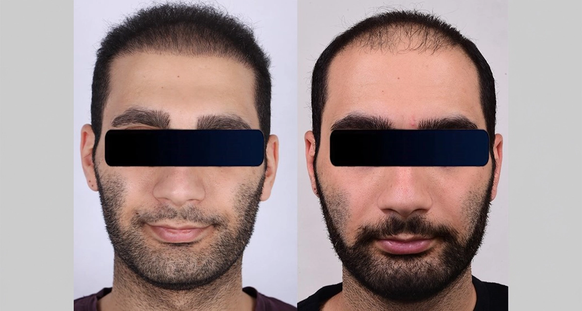 عکس قبل و بعد کاشت مو