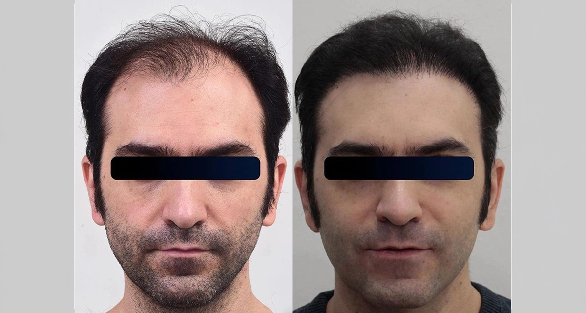 عکس قبل و بعد کاشت مو میکروگرافت