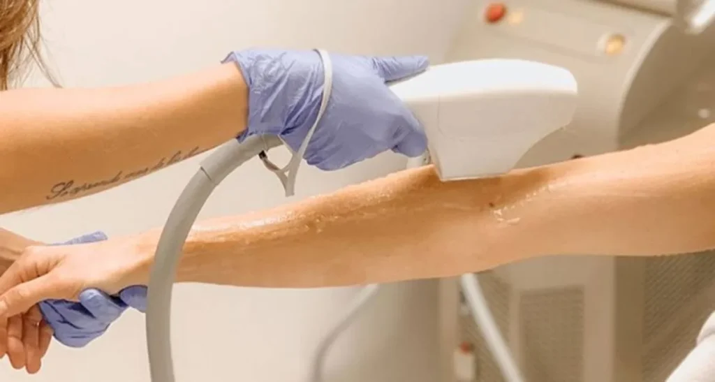 آیا لیزر موهای زائد برای موهای بور موثر است؟