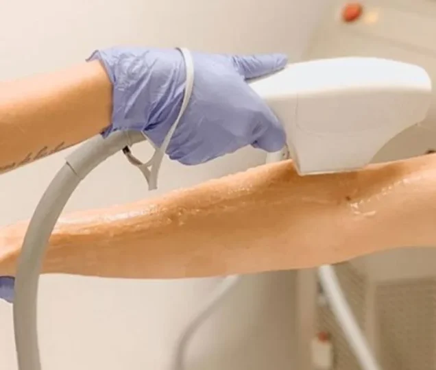 آیا لیزر موهای زائد برای موهای بور موثر است؟