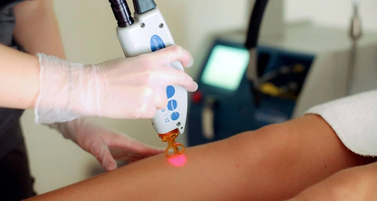 آیا می توان بعد از رفع موهای زائد بوسیله لیزر، پوست خود را برنزه کرد؟