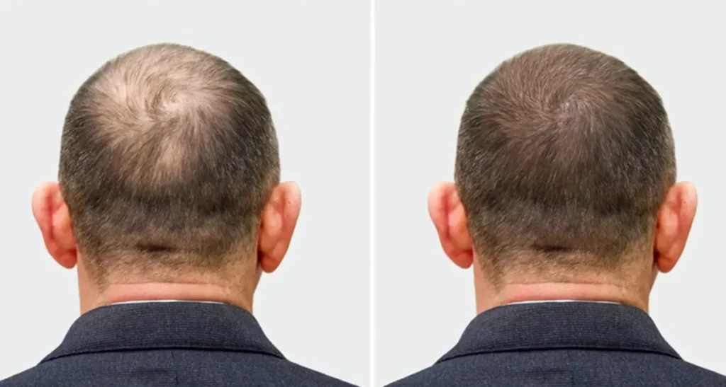 شرایط لازم جهت کاشت مو چیست؟