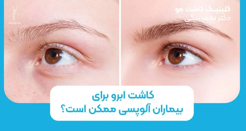 کاشت ابرو برای بیماران آلوپسی ممکن است؟