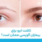 کاشت ابرو برای بیماران آلوپسی ممکن است؟