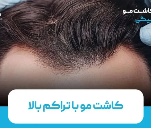 کاشت مو با تراکم بالا، روشی جدید برای دستیابی به ظاهری طبیعی و شیک