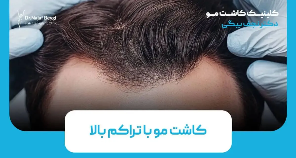 کاشت مو با تراکم بالا، روشی جدید برای دستیابی به ظاهری طبیعی و شیک