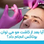 آیا بعد از کاشت مو می توان بوتاکس انجام داد؟