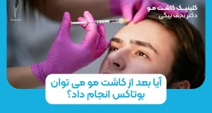 آیا بعد از کاشت مو می توان بوتاکس انجام داد؟