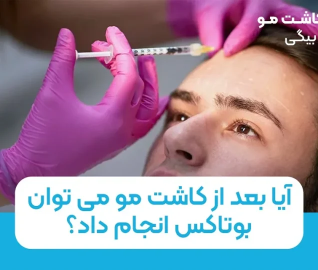 آیا بعد از کاشت مو می توان بوتاکس انجام داد؟