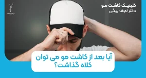 آیا بعد از کاشت مو می توان کلاه گذاشت؟