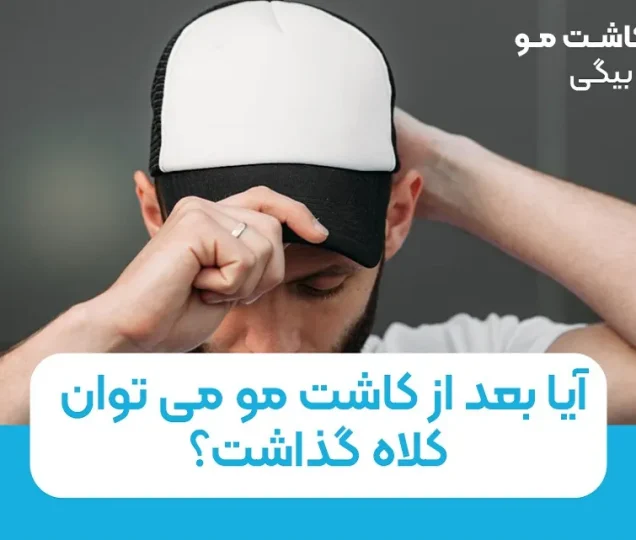 آیا بعد از کاشت مو می توان کلاه گذاشت؟