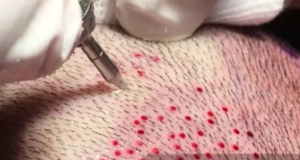 بهترین سن برای کاشت مو در زنان