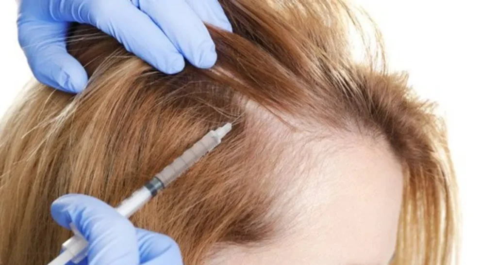 تفاوت مزوتراپی مو و پی آر پی مو