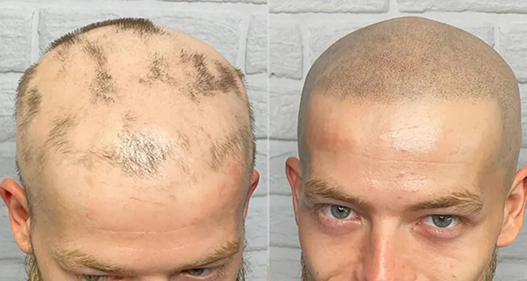 تکنیک اسکالپ موی سر چیست