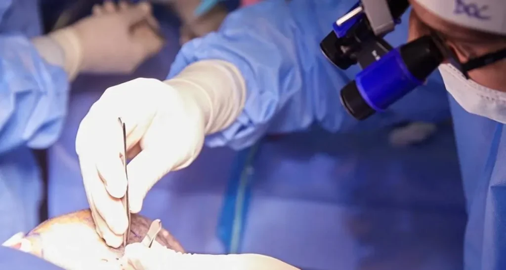 حداکثر سن کاشت مو در زنان